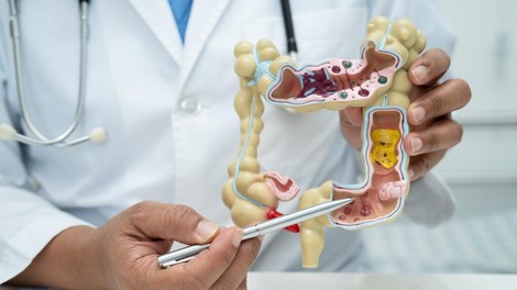 črevesje, rak, hrana