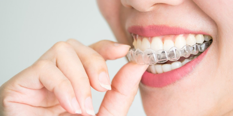 Kako doseči hollywoodski nasmeh z nevidnimi aparati Invisalign?