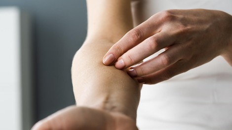 Nenavaden znak na koži opozarja na bolezni srca, pravijo dermatologi